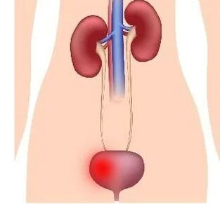 The reasons for the development of cystitis in women