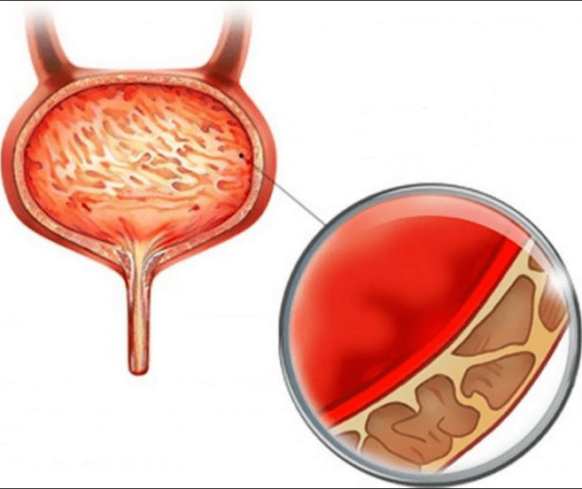 Inflammation of cystitis