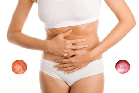 Cystitis